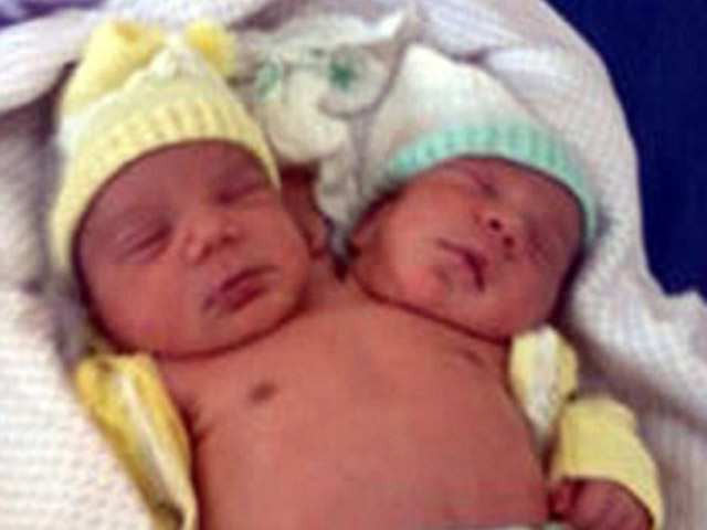 Жительница Бразилии родила двухголового младенца